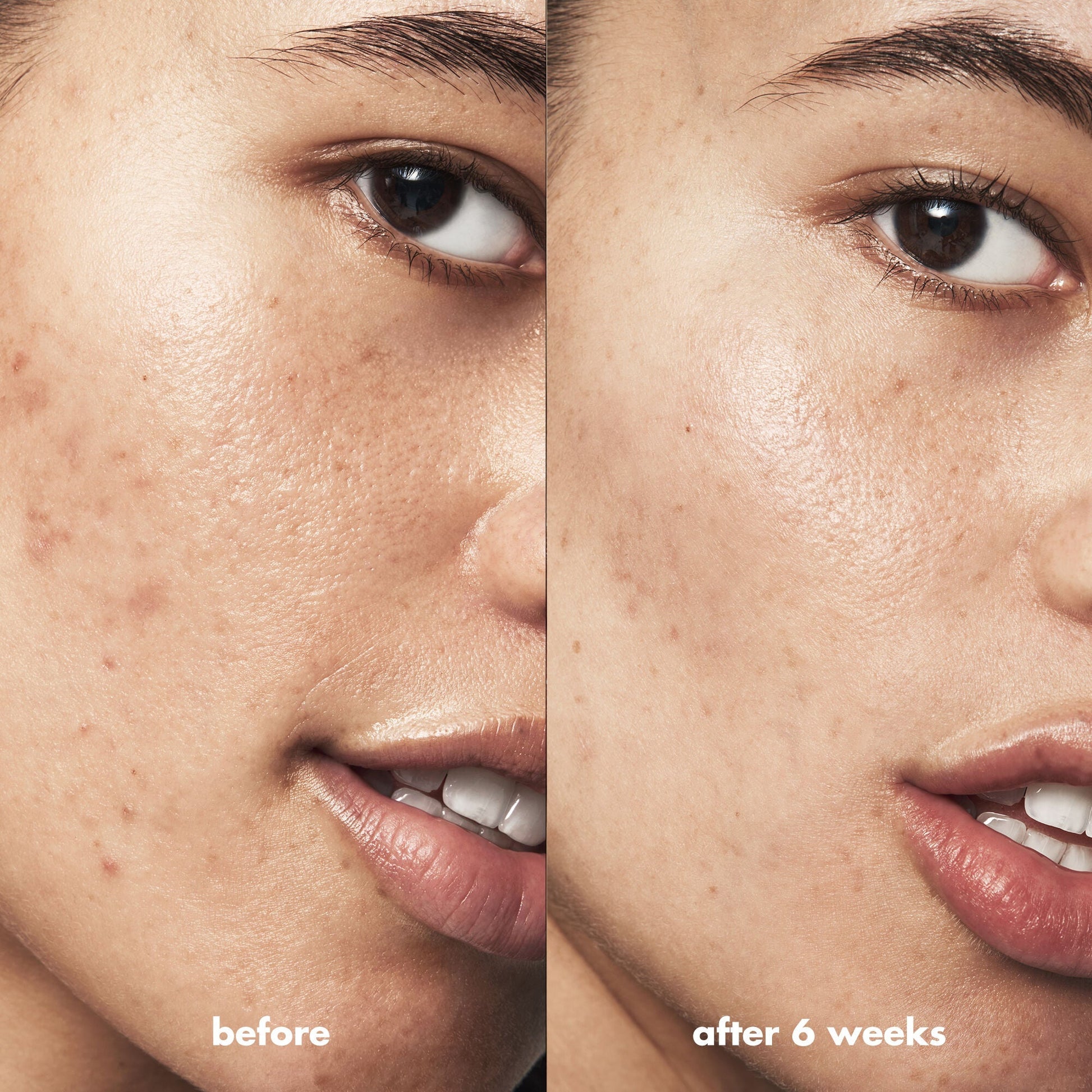 blemish-breakthrough-acne-calming-water-cream-r4 Acne_PDP_Isabella_Before_After_84ce713a-22d2-4bb9-aad7-445c7b27b1c9.jpg