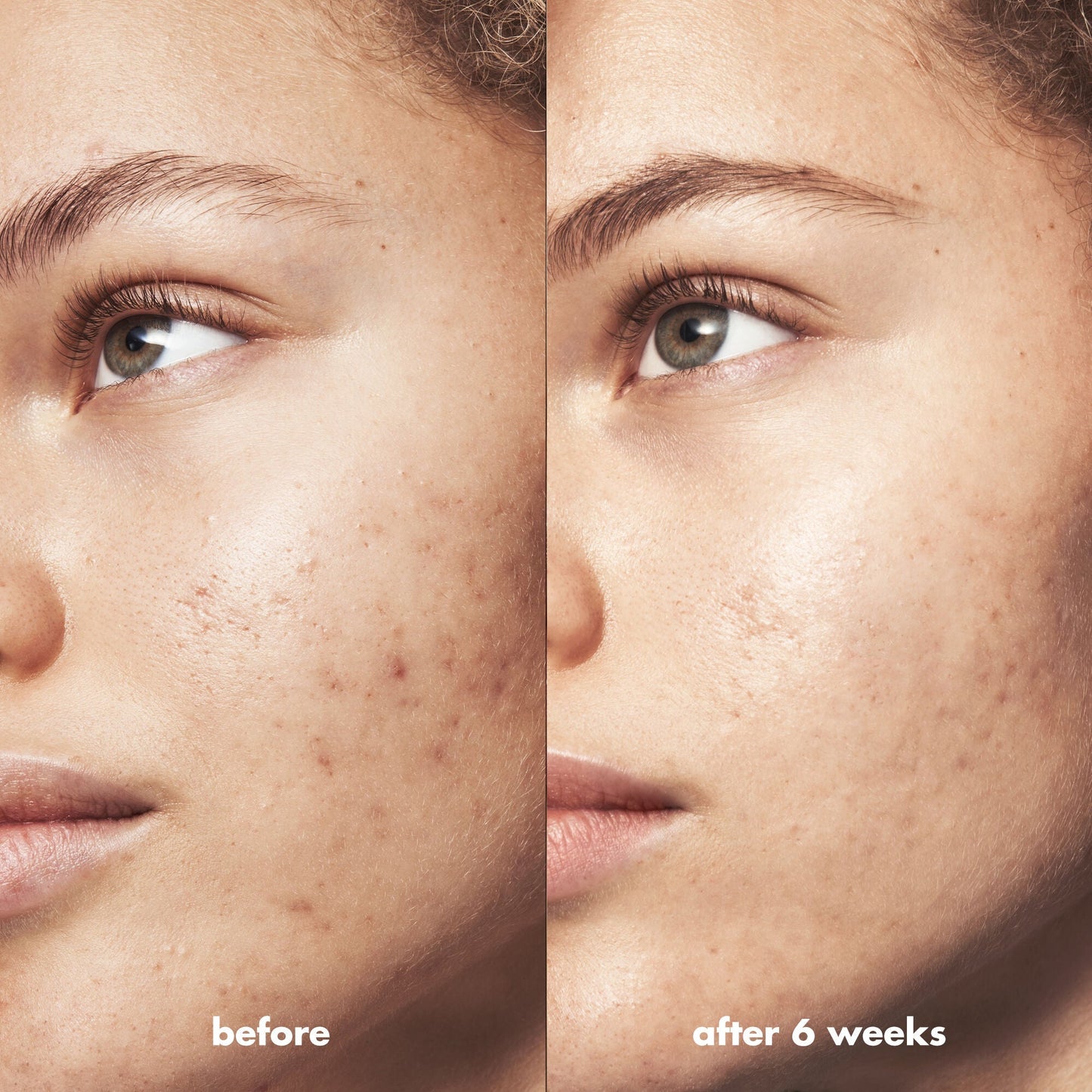 blemish-breakthrough-blemish-control-basics-kit-z0 Acne_PDP_Marley_Before_After_295728d2-6728-4f48-b8ef-c82bbca5b591.jpg